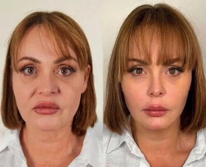Imagem da notícia Gaby Spanic faz harmonização facial após desistência de 'A Fazenda 17'