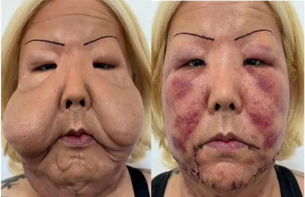 Imagem da notícia Juju do Pix passa por cirurgia para retirar óleo mineral do rosto