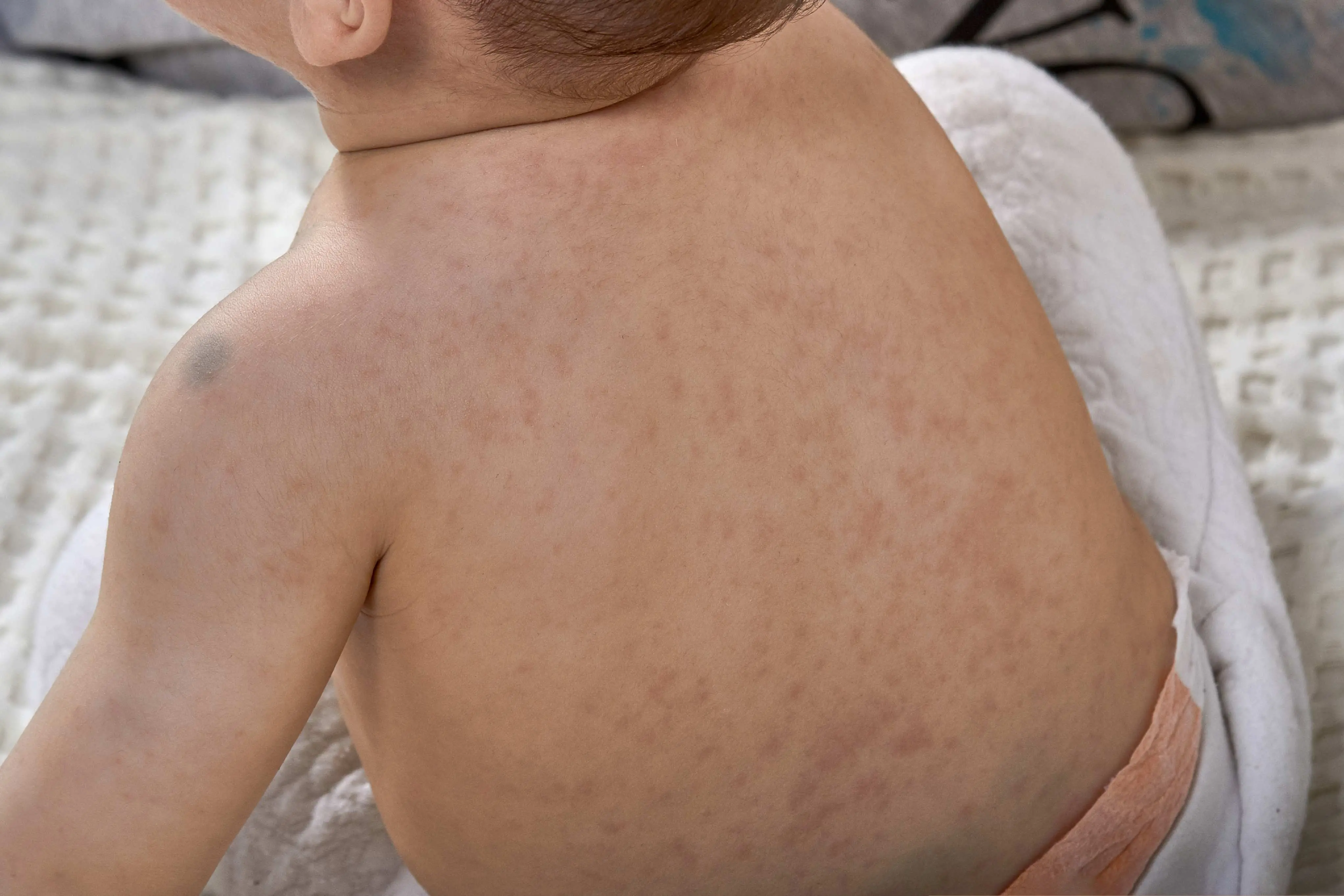 Imagem que mostra a presença de manchas no corpo para matéria sobre meningite.