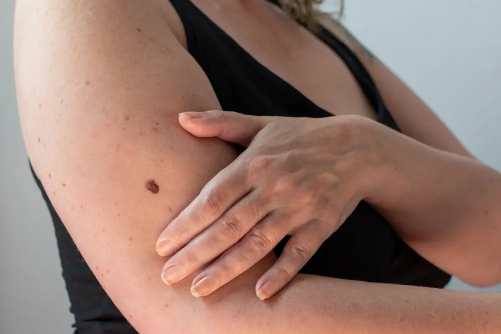 foto de mulher com mancha segurando o braço.