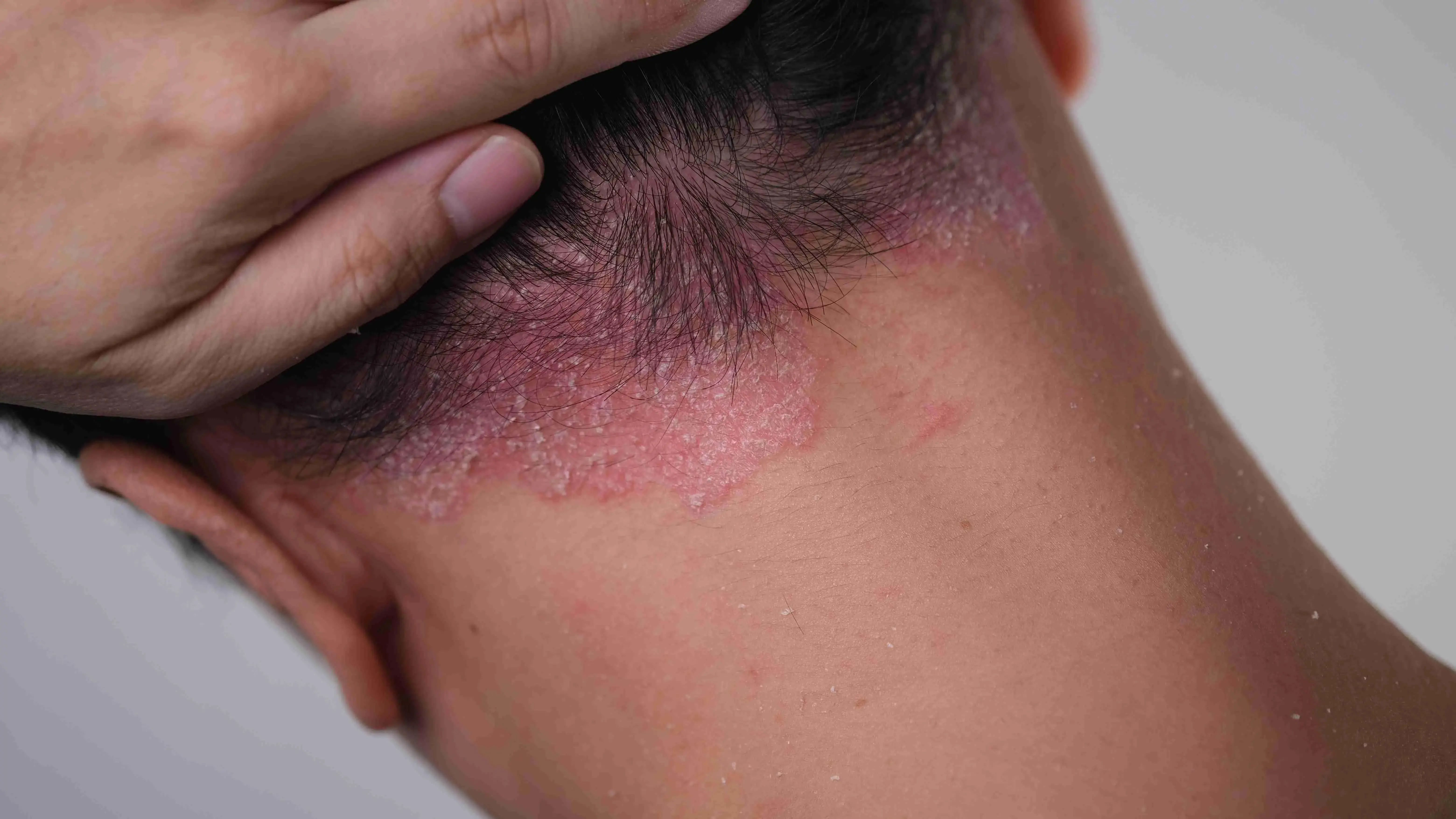 Imagem de close-up mostrando dermatite seborreica no couro cabeludo e nuca de uma pessoa, com placas vermelhas e escamosas.