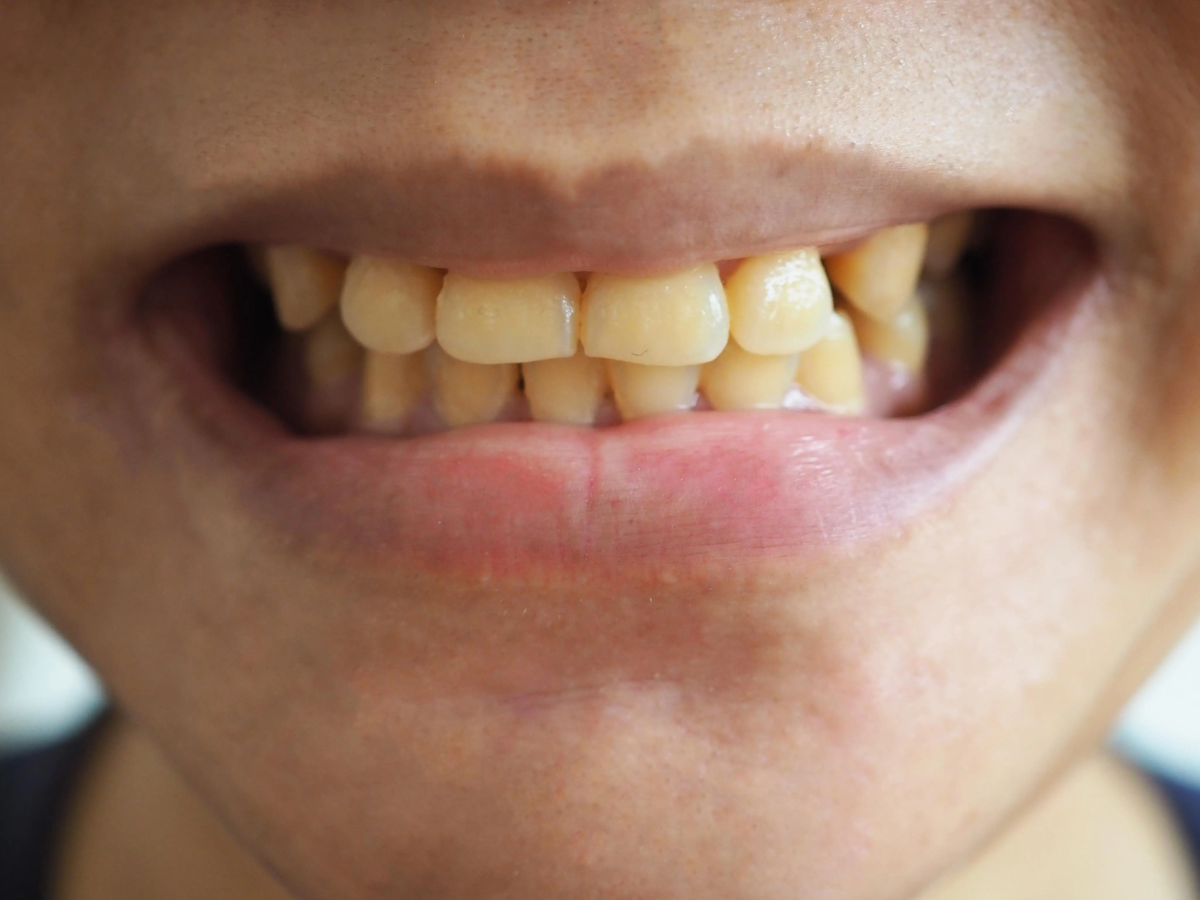 Imagem de um dente amarelado para matéria sobre alimentos que mancham os dentes.