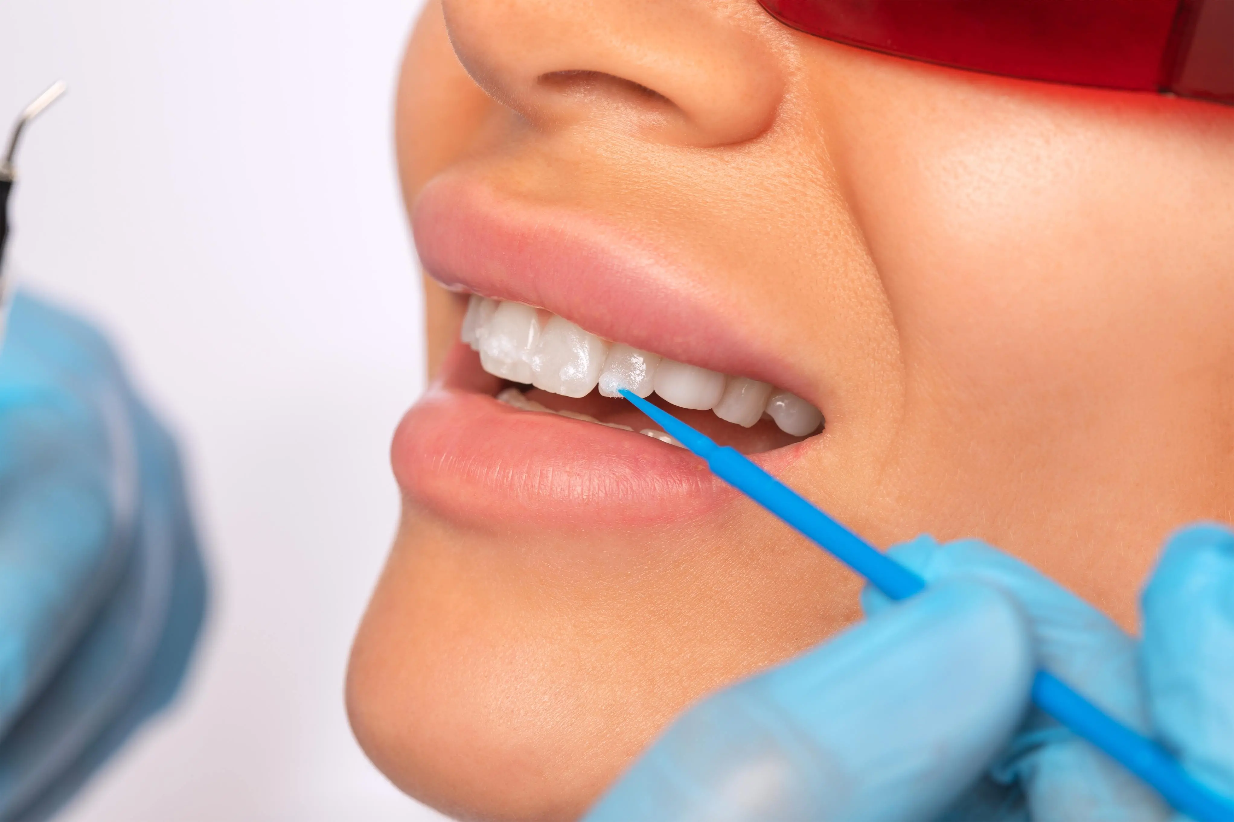 Imagem de um processo de clareamento dos dentes.