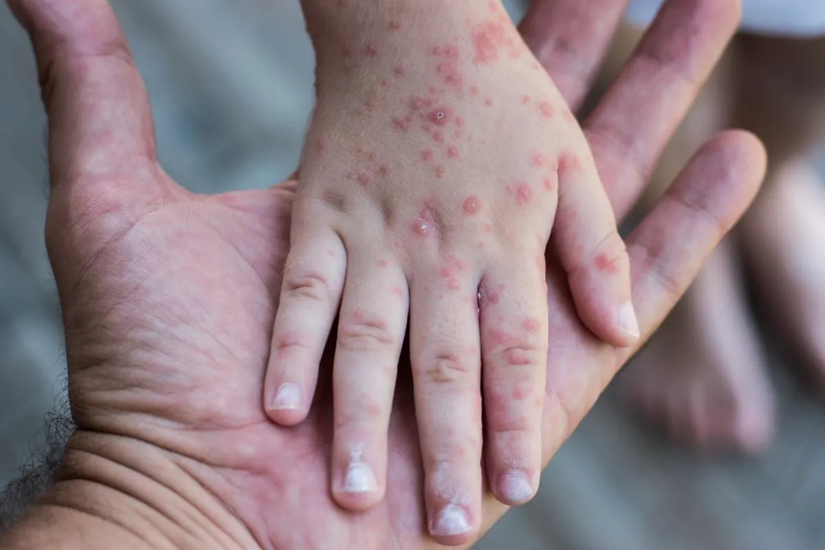 O uso de pomadas sem corticoide nas regiões com erupções é recomendado para aliviar a dor