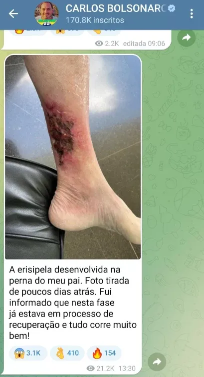 A erisipela é um processo infeccioso da pele provocado por uma bactéria que se propaga pelos vasos linfáticos