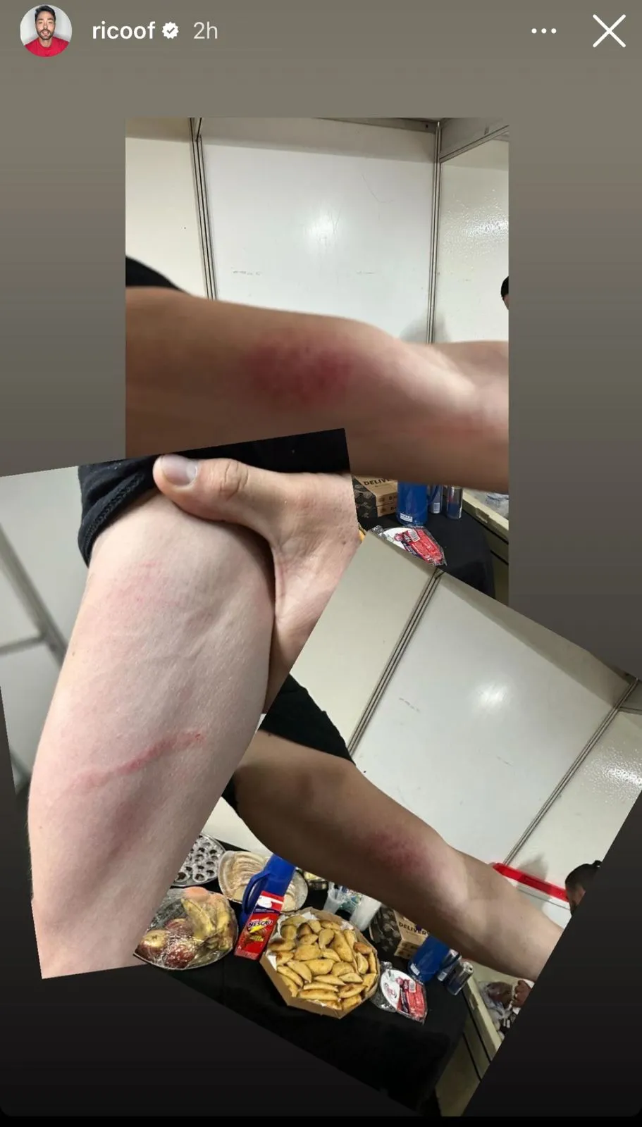 Rico diz que também ficou machucado ao tentar separar as brigas: 