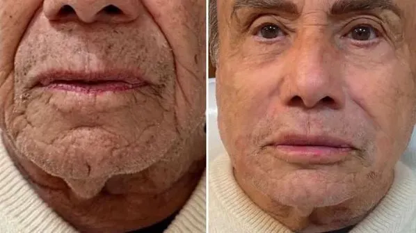 Stênio mudou detalhes da boca e até da sobrancelha
