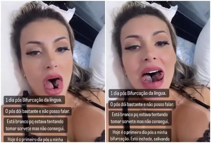 Andressa Urach compartilhou novo procedimento estético