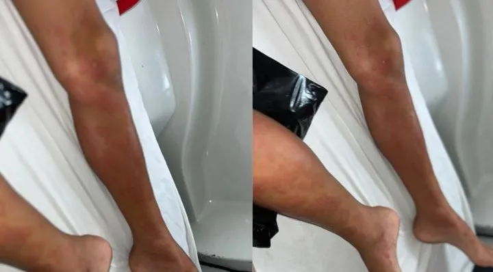 Criança teve crise alérgica a dipirona, segundo a mãe