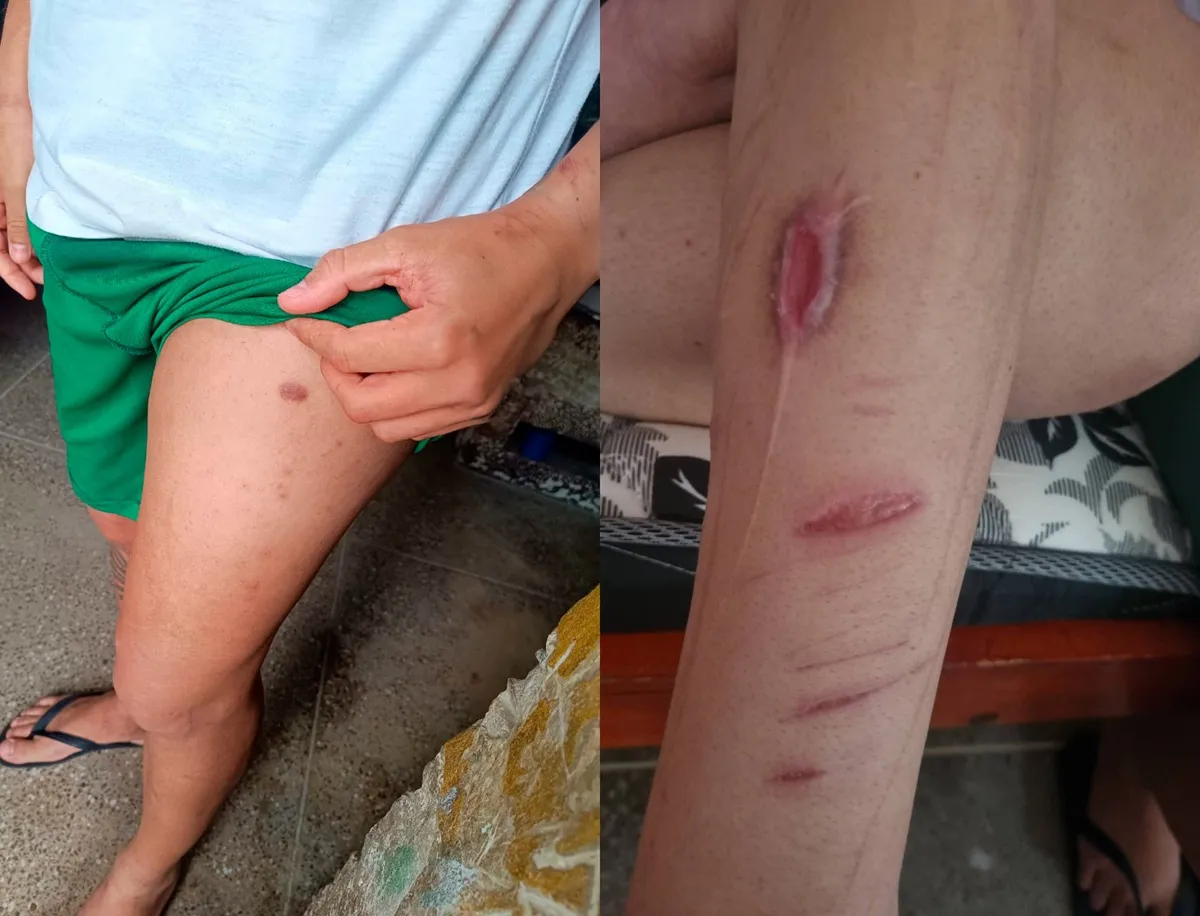 (1) Bala alojada na coxa de adolescente no momento da apreensão não foi retirada / (2) Marcas de autoflagelação feitas por uma adolescente