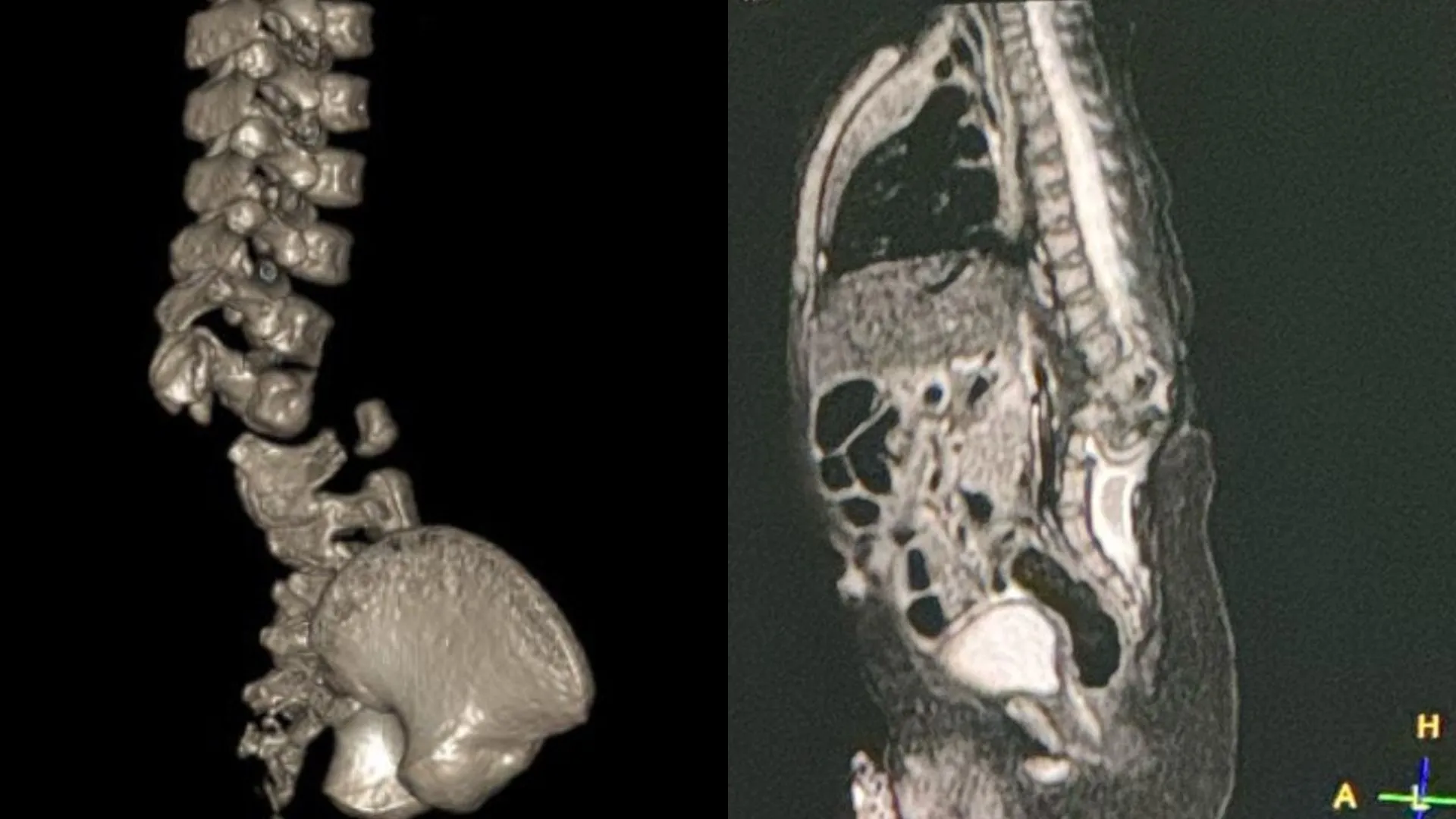 A Mielomeningocele é a forma mais grave da espinha bífida, caracterizada pelo não fechamento da coluna e pela exposição da medula espinhal e das meninges