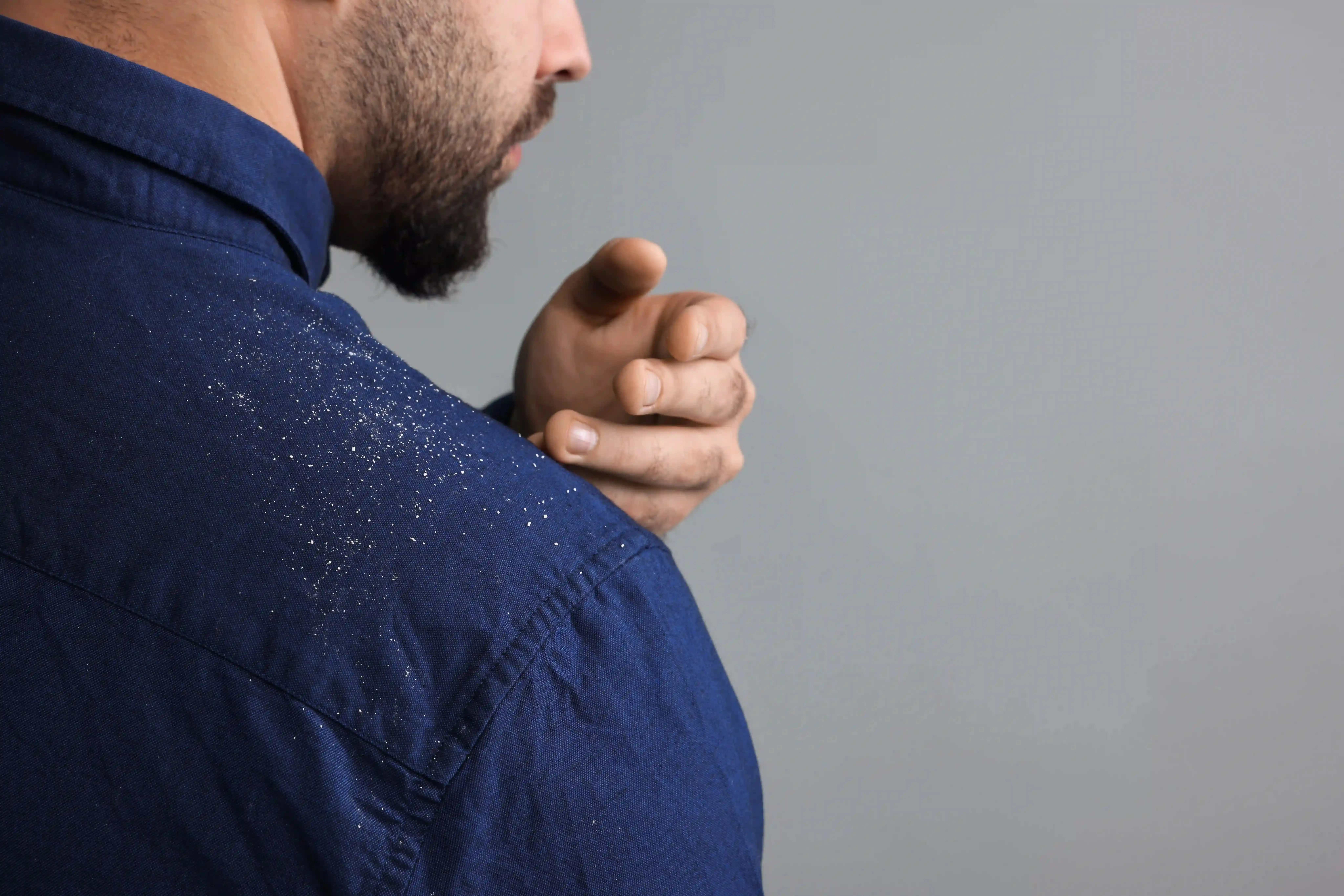 Homem de camisa azul escura com flocos de caspa para matéria sobre coceira no cabeça, o que pode ser