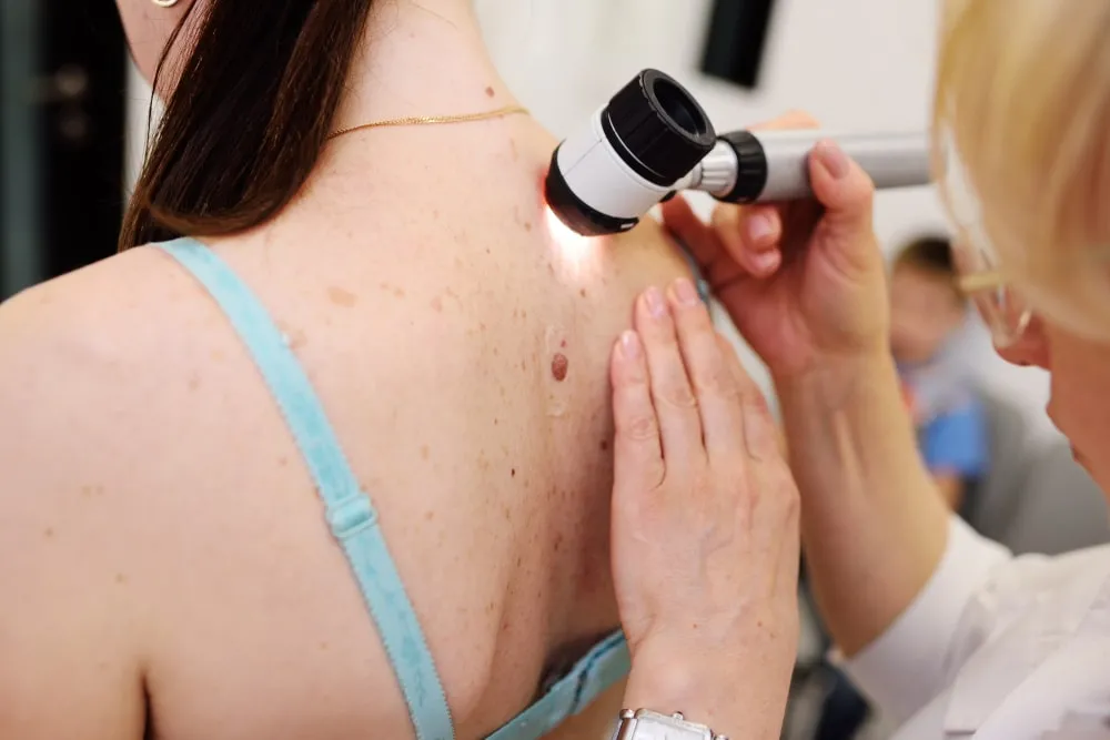 O exame de dermatoscopia é fundamental para a detecção precoce do melanoma.