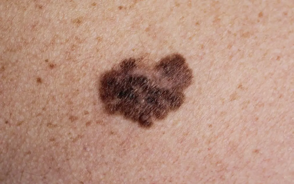 foto de pinta irregular de cor marrom com indícios de câncer de pele.